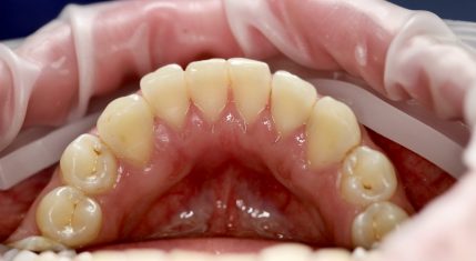 Клинический пример лечения зубов в GK Clinic — результат